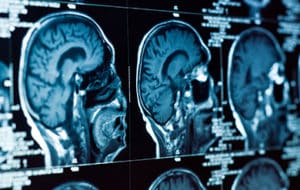 Workplace Accidents Leading to Brain Injuries: What Are Your Rights and Legal Options?